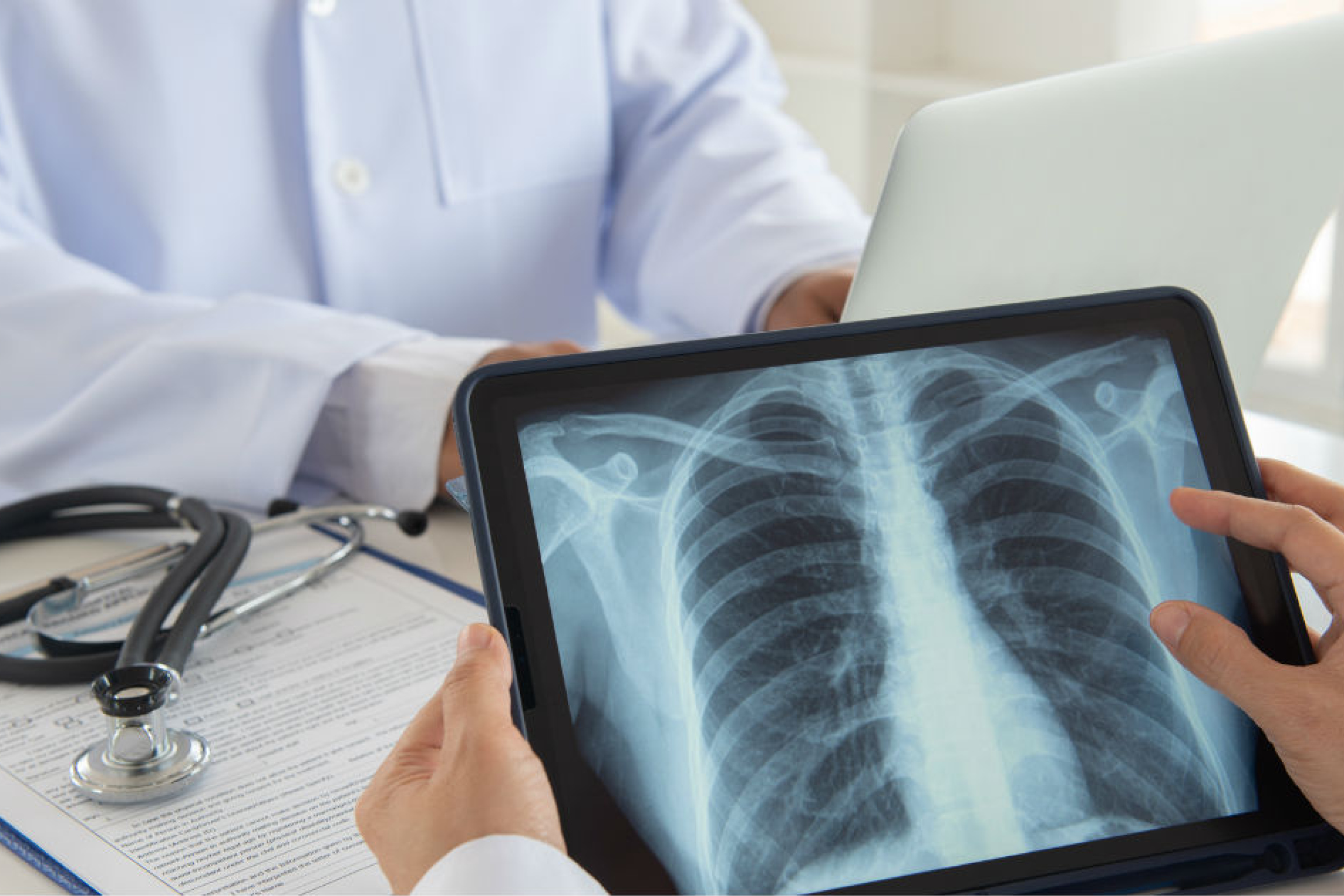 Lung Cancer Prevention: The Importance of Lung Screenings image