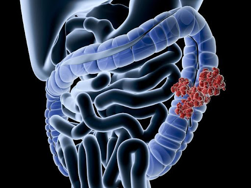Common Misconceptions of Colorectal Cancer image