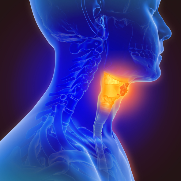 Thyroid Cancer image