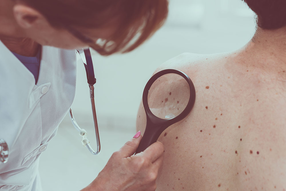 Melanoma Skin Cancer – May Cancer Awareness image