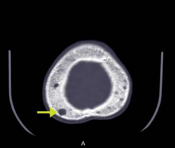 Lytic Lesions in Thal Major image