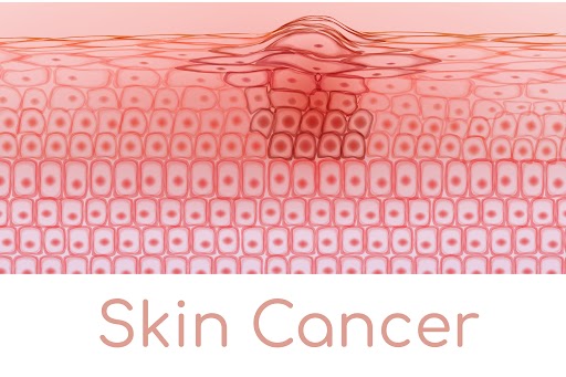 5 Common Skin Cancer Myths and The Facts image
