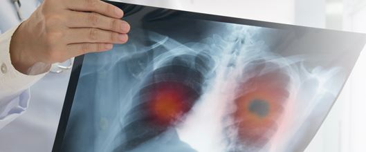 November is Lung Cancer Awareness Month image